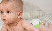 Бум в случаите на варицела в Плевен