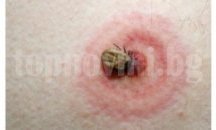 Два случая на Марсилска треска има в Старозагорско