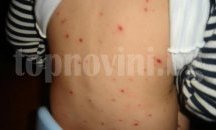 18 нови случая на варицела са регистрирани в Плевенско