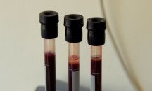 Свършиха безплатните тестове за хепатит в УМБАЛ - Русе, открит е един положителен резултат