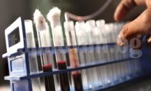 Мъж на 41 години е последният случай на СПИН в Добрич