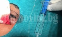 Лекари от Плевен извадиха 10-сантиметров паразит от окото на пациент (СНИМКА 18+)