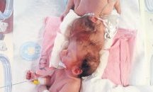 Хърватски лекари успешно разделиха сиамски близначки