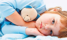 Проф. Кантарджиев: Проблемът с морбили е най-голям в София